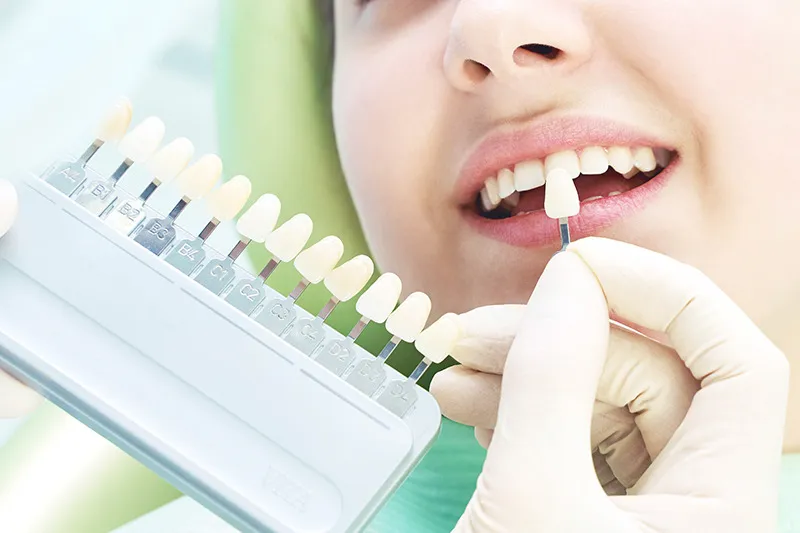 歯科連携の薬剤使用のホワイトニング