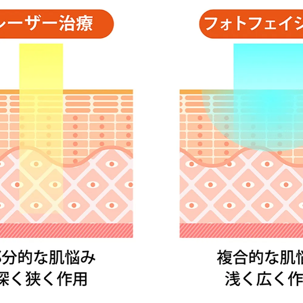 【蒲田で光フォトフェイシャル】