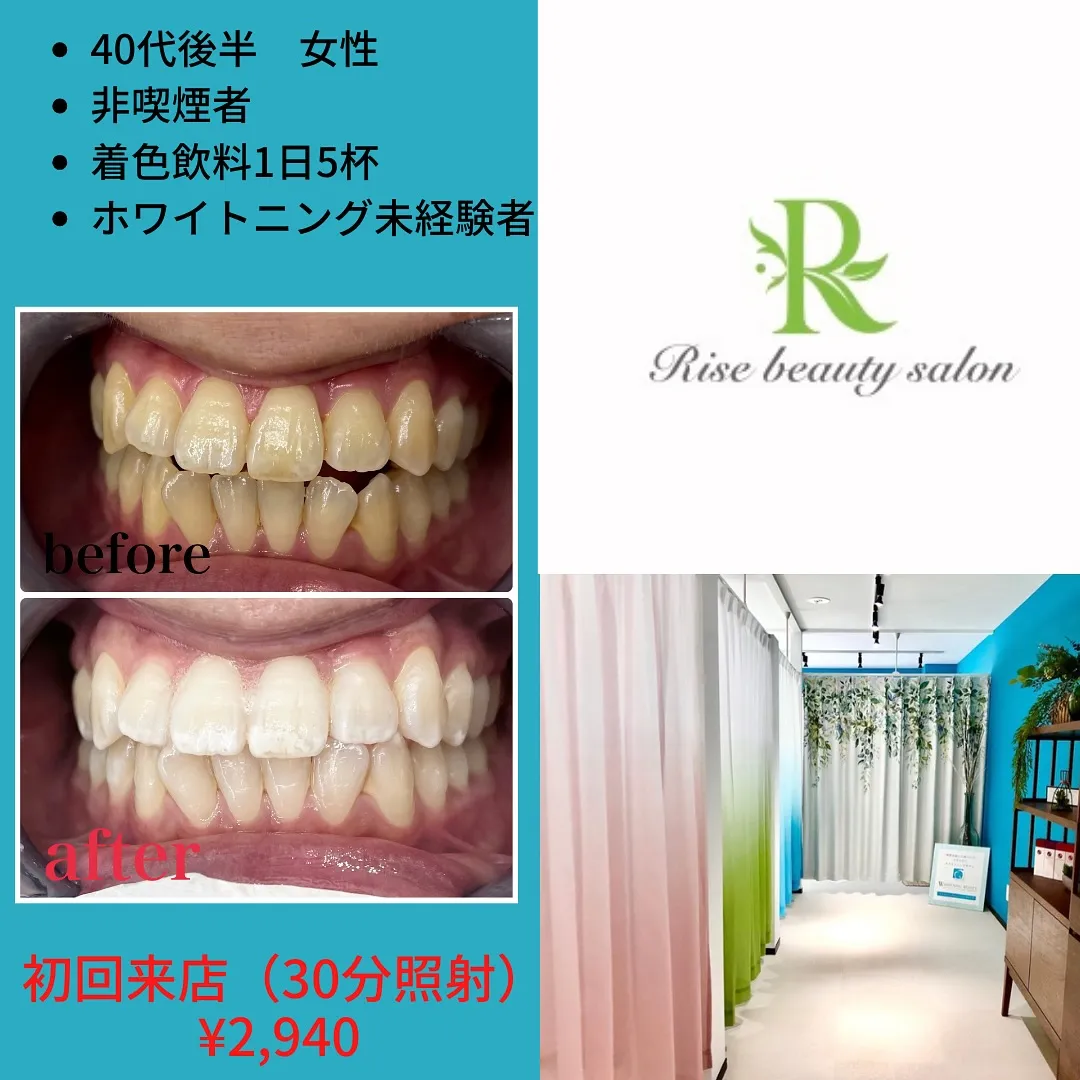 【イベントに向けて蒲田でホワイトニング】