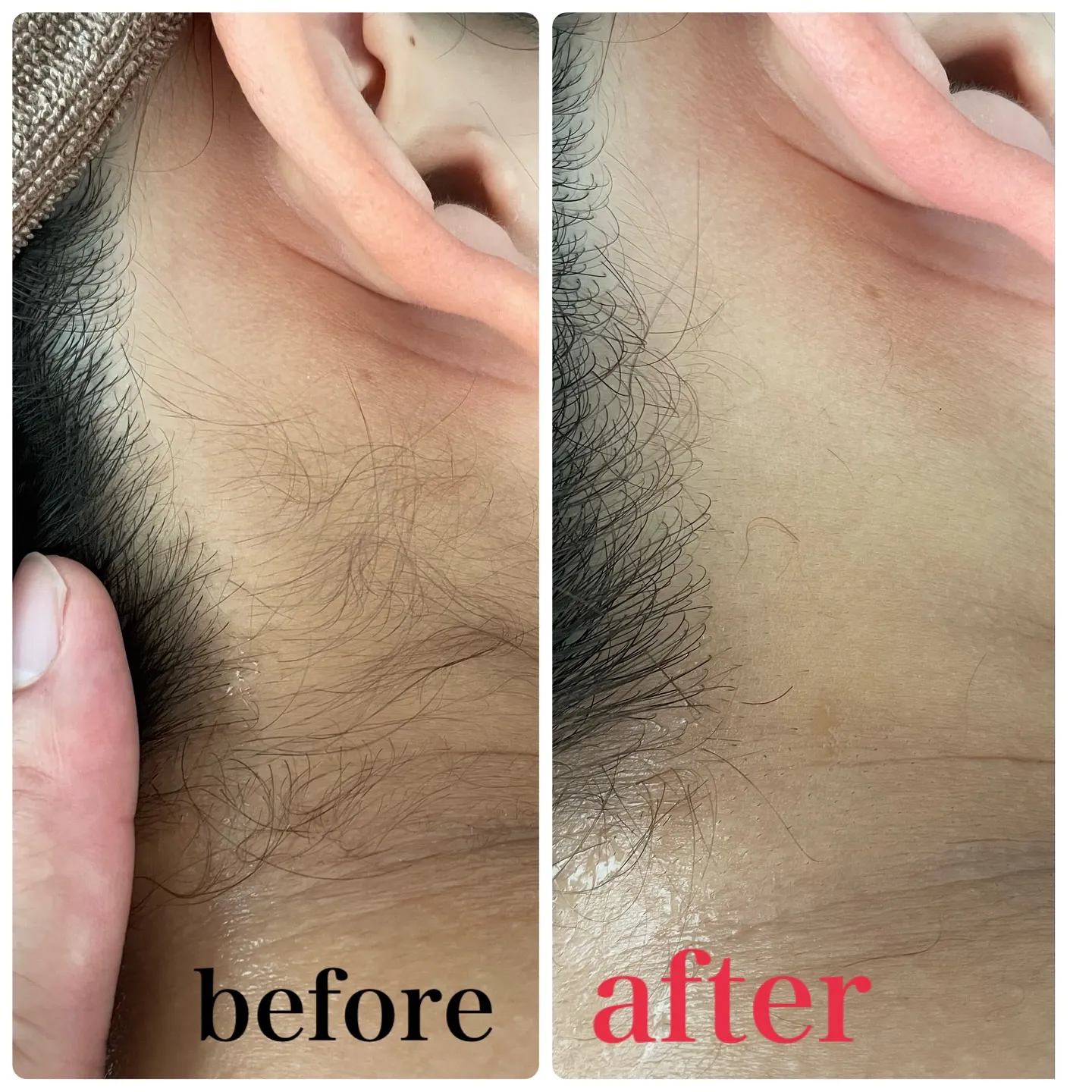 【うなじ脱毛で首元美人✨　蒲田】