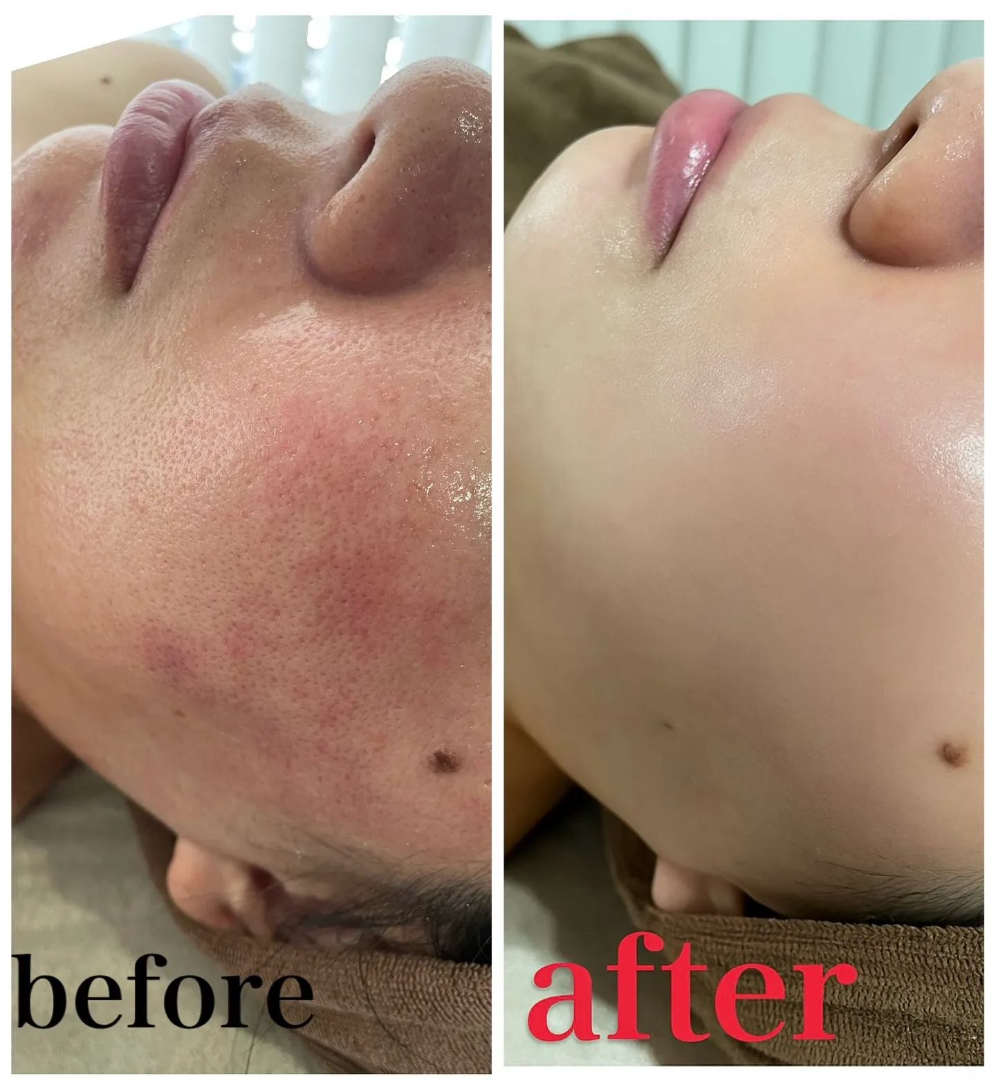 【蒲田で乾燥肌によるたるみ毛穴ケア✨うるおいハリ肌へ】