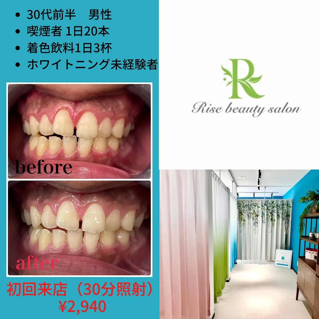 【大森／年齢問わず🦷ホワイトニングで歯は白くなる？】