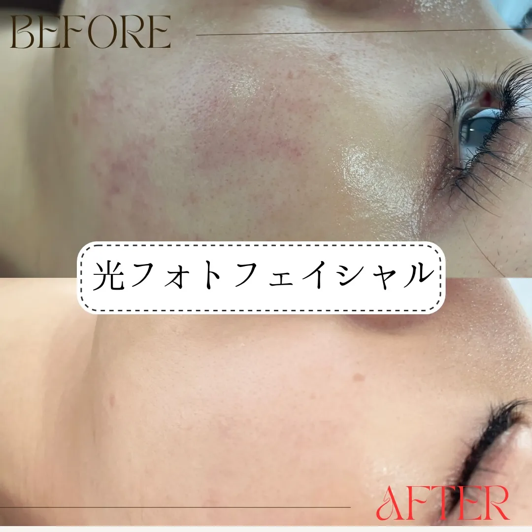 【蒲田で光フォト❣️冬の乾燥肌に合わせたしっとりケア】